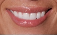 Dental Crowns | Dentist in Nyack, NY | Piermont Dental Care